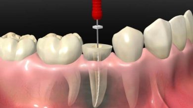 5-essential-tips-for-recovering-after-root-canal-treatment